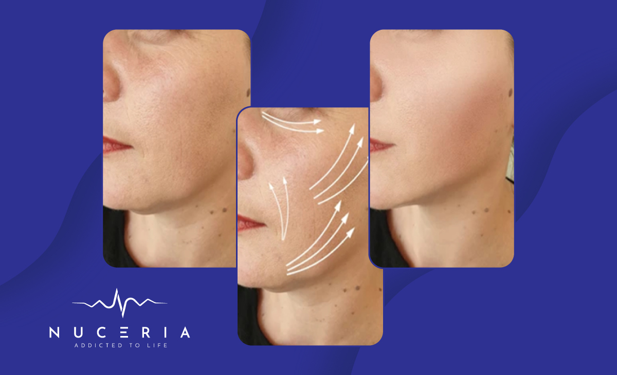 Endolift Recovery Miami: Day-by-Day Timeline & Healing Guide